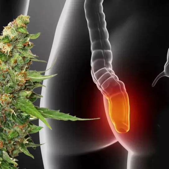 Cannabis y cáncer de colón