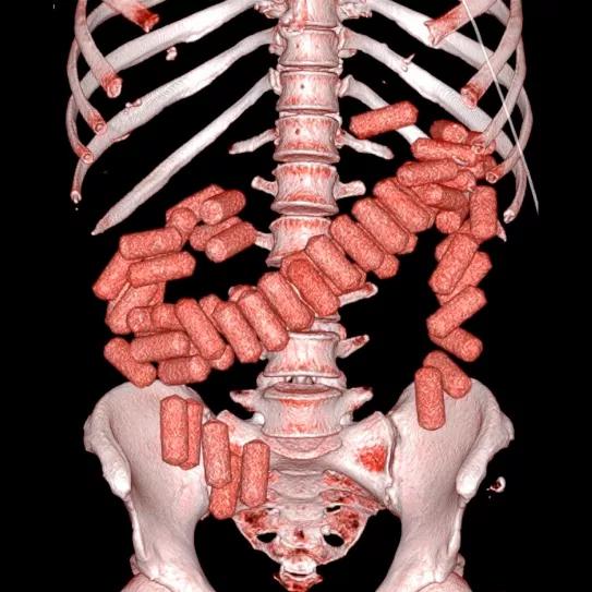 Tres detenidos por la muerte de una persona que transportó cocaína en su interior