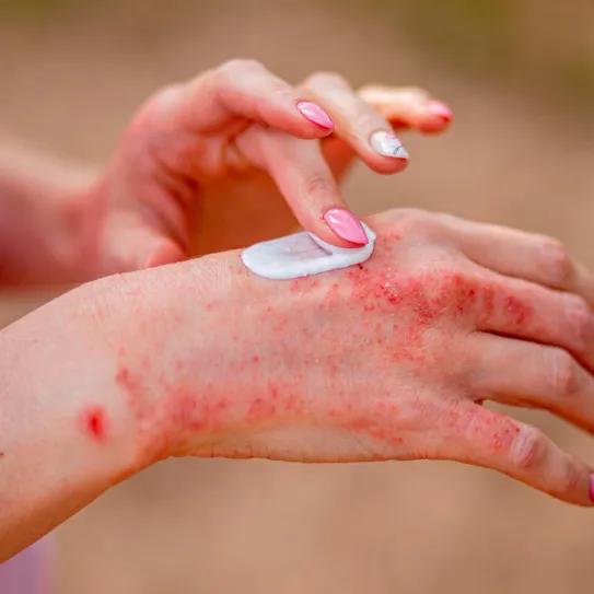 Descubren que el cannabis es eficaz para combatir una de las enfermedades más comunes de la piel