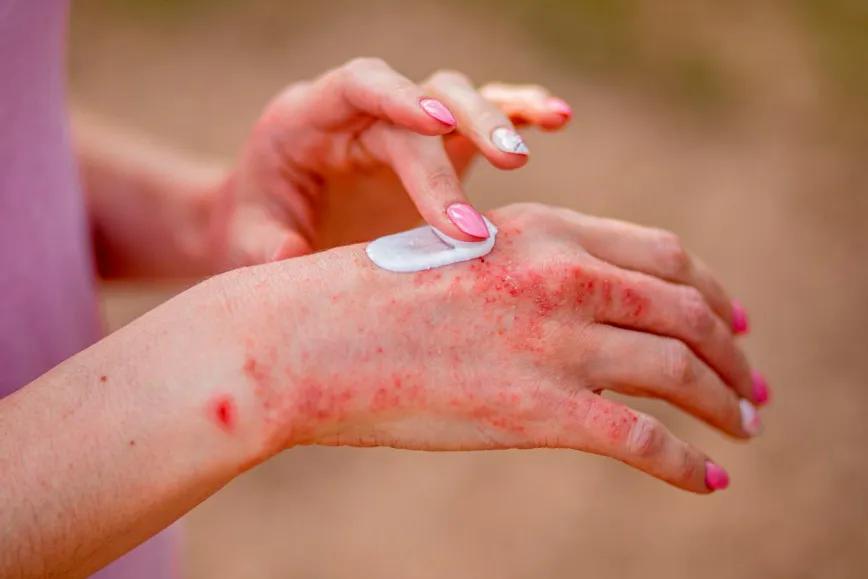 Descubren que el cannabis es eficaz para combatir una de las enfermedades más comunes de la piel