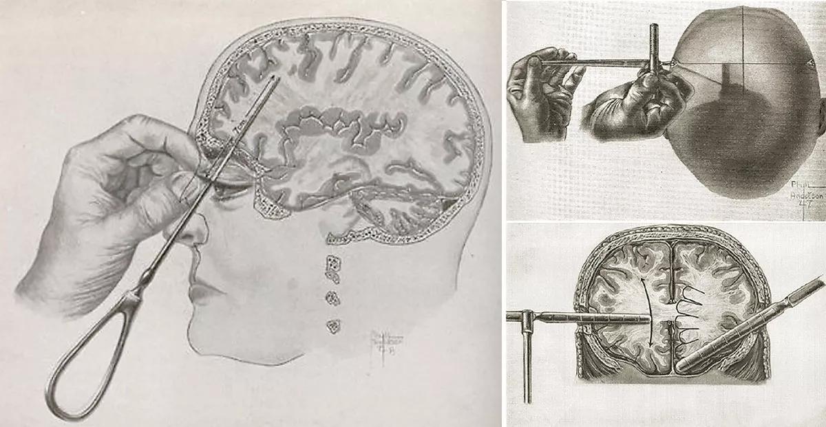 Egas Moniz, inventor de la lobotomía frontal