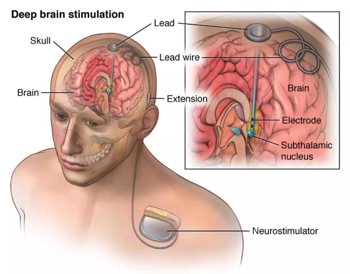 Una universidad estadounidense estudia la cirugía para tratar la adicción